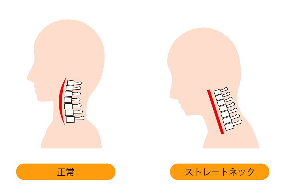 スマホ首